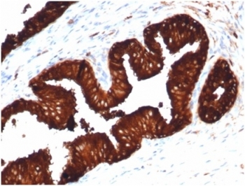 Recombinant PSA Antibody KLK3/4602R IHC staining of human prostate carcinoma. Immunohistochemistry analysis of FFPE human prostate carcinoma tissue using Recombinant PSA Antibody KLK3/4602R shows strong HRP-DAB brown cytoplasmic staining in malignant glandular epithelial cells forming tumor glands, consistent with Prostate specific antigen (KLK3) expression in prostate-derived carcinoma cells, while surrounding stromal cells are largely negative. HIER: tissue sections were boiled in pH 9 10mM Tris with 1mM EDTA for 20 minutes and allowed to cool before testing.