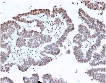 FOXI1 Antibody Prostate IHC. Immunohistochemistry analysis of FFPE human prostate tissue stained with FOXI1 Antibody / Forkhead Box Transcription Factor Marker (clone PCRP-FOXI1-1F8). Nuclear HRP-DAB brown staining is observed in prostate epithelial cells, consistent with the transcription-associated localization expected for Forkhead box protein I1 / FOXI1. Sections underwent HIER using 10mM Tris with 1mM EDTA buffer, pH 9, followed by incubation with FOXI1 antibody at 2ug/ml prior to chromogenic detection.