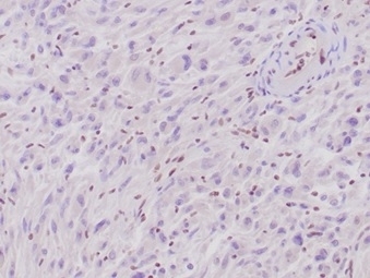IHC staining of FFPE human epithelioid sarcoma tissue with SMARCB1 antibody (clone rSMARCB1/4588). Note loss of nuclear expression in tumor cells and retained positivity in normal cells. HIER: boil tissue sections in pH 9 10mM Tris with 1mM EDTA for 20 min and allow to cool before testing.