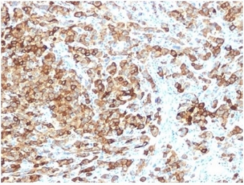 Immunohistochemistry analysis of PMEL17 antibody in human melanoma tissue. FFPE human melanoma sections show strong HRP-DAB brown cytoplasmic and membranous staining in tumor cells, consistent with premelanosome-associated localization of PMEL protein in melanocytic cells. Staining highlights clusters and sheets of melanoma cells, while adjacent stromal elements show minimal background signal. Heat induced epitope retrieval was performed in 10 mM Tris with 1 mM EDTA, pH 9.0, by boiling for 20 minutes followed by cooling prior to antibody incubation.