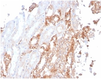Immunohistochemistry of Alpha Fodrin antibody in human renal cell carcinoma tissue. FFPE renal cell carcinoma shows cytoplasmic HRP-DAB brown staining within tumor epithelial cells, consistent with Spectrin alpha chain, non-erythrocytic 1 localization along the submembranous cytoskeleton. Clone SPTAN1/3506 was used for detection and is Microarray Specificity Validated. Heat-induced epitope retrieval was performed by boiling tissue sections in pH 9 10 mM Tris with 1 mM EDTA for 20 minutes followed by cooling prior to staining.