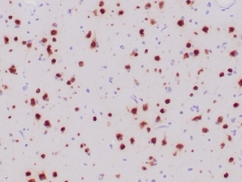NeuN Antibody Human Ganglioma Tissue Immunohistochemistry. IHC staining of FFPE human ganglioma tissue with recombinant NeuN antibody (clone NeuN/6694R). HIER: boil tissue sections in pH 9 10mM Tris with 1mM EDTA for 20 min and allow to cool before testing.