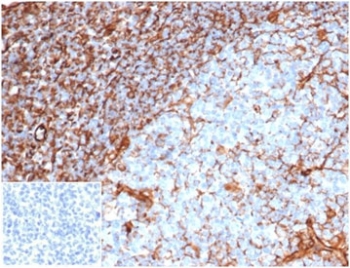 VIM Antibody / Cellular Stress Response Marker Antibody Tonsil IHC. Immunohistochemistry analysis of FFPE human tonsil tissue using Vimentin antibody shows strong HRP-DAB brown cytoplasmic staining in stromal and mesenchymal cell populations, with minimal staining in most lymphoid cells. The recombinant rabbit monoclonal clone rVIM/6914 highlights filamentous cytoplasmic structures with variable intensity across the stromal compartment, consistent with heterogeneous cellular states. This variation in staining intensity is consistent with cytoskeletal responses associated with cellular stress and activation. The negative control inset, using PBS in place of primary antibody, shows no significant staining, confirming specificity of the observed signal.