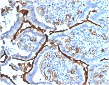 Angiotensin Converting Enzyme Antibody Colon Carcinoma IHC. Immunohistochemistry analysis of FFPE human colon carcinoma tissue using Angiotensin Converting Enzyme Antibody (clone ACE/3764) shows strong membranous staining highlighting vascular endothelial cells within the tumor microenvironment, consistent with ACE / CD143 localization as a cell surface enzyme. The staining delineates vessel structures interspersed throughout the tumor, while tumor epithelial cells display comparatively lower signal. Hematoxylin counterstain provides nuclear contrast and tissue architecture. Antibody incubation was performed at 2 ug/ml in PBS for 30 min at RT. HIER: boil FFPE tissue sections in pH 9 10 mM Tris with 1 mM EDTA for 20 min and allow to cool before testing.