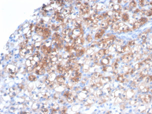 Recombinant HSP27 Antibody HSPB1/7038R Staining of Human Renal Cell Carcinoma IHC. Immunohistochemistry testing of FFPE human renal cell carcinoma tissue with Recombinant HSP27 Antibody clone HSPB1/7038R shows strong brown immunoreactivity in tumor cells, with a predominantly cytoplasmic staining pattern. HIER was performed by boiling tissue sections in pH 9, 10 mM Tris with 1 mM EDTA for 20 min followed by cooling before antibody testing.