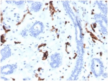 FABP4 Antibody Breast Carcinoma IHC. Immunohistochemistry analysis of FFPE human breast carcinoma tissue using FABP4 Antibody / Adipocyte Lipid Metabolism Marker clone FABP4/4424 at 2 ug/ml. Stromal and adipocyte-associated cell populations demonstrate cytoplasmic HRP-DAB brown staining consistent with the role of FABP4 in intracellular fatty acid transport, adipocyte lipid metabolism, and metabolic-inflammatory signaling pathways within the breast tumor microenvironment. Nuclei are counterstained blue. Heat-induced epitope retrieval was performed by boiling tissue sections in pH9 10 mM Tris with 1 mM EDTA for 20 minutes followed by cooling prior to staining.
