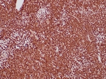 Aldehyde Dehydrogenase 1A1 Antibody Sarcoma IHC. Immunohistochemistry staining of FFPE human sarcoma tissue with Aldehyde Dehydrogenase 1A1 antibody (clone ALDH1A1/4793) at 2ug/ml. HIER: boil tissue sections in pH 9 10mM Tris with 1mM EDTA for 20 min and allow to cool before testing.