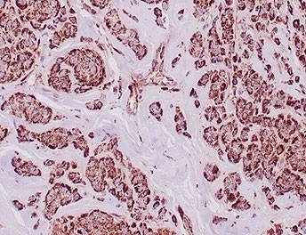 Aldehyde Dehydrogenase 1A1 Antibody Breast Carcinoma IHC. Immunohistochemistry staining of FFPE human breast carcinoma tissue with Aldehyde Dehydrogenase 1A1 antibody (clone ALDH1A1/4793) at 2ug/ml. HIER: boil tissue sections in pH 9 10mM Tris with 1mM EDTA for 20 min and allow to cool before testing.