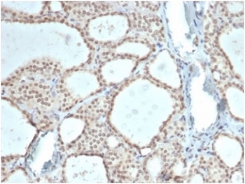 ZHX3 Antibody Thyroid IHC. Immunohistochemistry analysis of FFPE human thyroid tissue stained with ZHX3 Antibody / Transcriptional Regulation Marker (clone PCRP-ZHX3-1G3). Strong nuclear HRP-DAB brown staining is observed in thyroid epithelial cells, consistent with the expected nuclear localization of Zinc fingers and homeoboxes protein 3 / ZHX3 as a transcription-associated regulatory protein involved in gene expression control and differentiation-associated signaling pathways. Sections underwent HIER using 10mM Tris with 1mM EDTA buffer, pH 9, prior to staining with antibody at 2ug/ml.