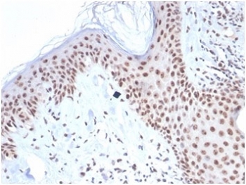 IHC staining of FFPE human basal cell carcinoma tissue with recombinant NPM1 antibody. HIER: boil tissue sections in pH 9 10mM Tris with 1mM EDTA for 20 min and allow to cool before testing.