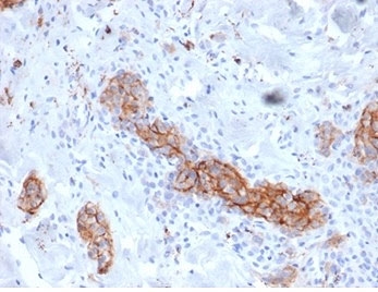 IHC staining of FFPE human melanoma tissue with NGFR/TNFRSF16 antibody (clone NGFR/4919) at 2ug/ml. HIER: boil tissue sections in pH 9 10mM Tris with 1mM EDTA for 20 min and allow to cool before testing.