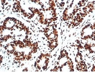 Ku80 Antibody Colon Carcinoma IHC. Immunohistochemistry analysis of FFPE human colon carcinoma tissue stained with Ku80 Antibody demonstrates strong predominantly nuclear HRP-DAB brown staining throughout malignant gland-forming epithelial tumor cell populations, consistent with XRCC5 / Ku80-associated DNA repair pathway expression. This non-homologous end joining antibody highlights double-strand break repair signaling and genomic stability-associated cellular regulation within colorectal carcinoma tissue. Hematoxylin counterstain highlights nuclei (blue), providing contrast to the Ku80-positive nuclear staining pattern.