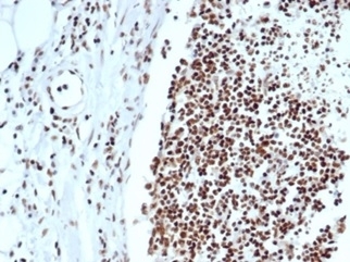 Ku80 Antibody Lymph Tissue IHC. Immunohistochemistry analysis of human lymph node tissue using Ku80 antibody clone XRCC5/7318. Formalin-fixed, paraffin-embedded sections show strong HRP-DAB brown nuclear staining within the lymphoid cell population, consistent with Ku80 (XRCC5) localization as part of the DNA-PK repair complex. The widespread nuclear signal reflects active assembly of DNA repair machinery in proliferative immune cells, where Ku80 participates in recruitment and stabilization of DNA-PKcs at sites of DNA damage. Hematoxylin counterstain highlights nuclei (blue), providing contrast to the Ku80-positive nuclear staining pattern.