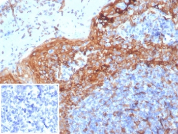 IHC TMEM173 Antibody Clone STING1/7432 in human tonsil. Immunohistochemistry analysis of TMEM173 Antibody Clone STING1/7432 in formalin-fixed paraffin-embedded human tonsil tissue. The mouse monoclonal antibody (clone STING1/7432) shows cytoplasmic HRP-DAB brown staining in immune cells within tonsillar lymphoid tissue, consistent with the intracellular localization of Stimulator of interferon genes (STING1 / TMEM173), an adaptor protein involved in cGAS-STING innate immune signaling. Lymphoid and stromal cells within the tonsil display positive staining patterns. The inset represents the negative control in which PBS was used instead of the primary antibody to evaluate secondary antibody background staining. Antigen retrieval was performed by boiling tissue sections in pH 9 Tris-EDTA buffer (10mM Tris, 1mM EDTA) for 20 minutes followed by cooling prior to antibody incubation.