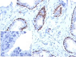 p40 Antibody for IHC. Immunohistochemistry analysis of Tumor protein p40 (deltaNp63) in FFPE human prostate cancer tissue using a p40 Antibody for IHC (clone P40/7302R) demonstrates strong HRP-DAB brown nuclear staining in basal epithelial cells outlining benign glandular structures, while malignant luminal tumor cells remain negative. The staining pattern highlights a preserved basal cell layer in non-neoplastic glands and a clear loss of basal cells in carcinoma regions, supporting interpretation of epithelial architecture and tumor-associated changes. The nuclear-restricted signal shows minimal background, enabling confident identification of deltaNp63-positive cell populations. Inset: PBS was used in place of the primary antibody as a negative control, showing no brown signal and confirming specificity of the staining. Heat-induced epitope retrieval was performed by boiling tissue sections in pH 9 10mM Tris with 1mM EDTA for 20 minutes followed by cooling prior to antibody incubation.