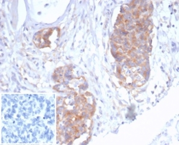 p40 Antibody for IHC. Immunohistochemistry analysis of Tumor protein p40 (deltaNp63) in FFPE human ovarian cancer tissue using a p40 Antibody for IHC (clone P40/7302R) demonstrates focal HRP-DAB brown nuclear staining in tumor cell clusters, while surrounding stromal elements remain largely negative. The nuclear-restricted staining pattern supports detection of deltaNp63-positive tumor cells and highlights areas of epithelial differentiation within the tissue. Staining intensity and distribution vary across tumor regions, reflecting heterogeneity in p40 expression. Inset: PBS was used in place of the primary antibody as a negative control, showing no brown signal and confirming specificity of the staining. Heat-induced epitope retrieval was performed by boiling tissue sections in pH 9 10mM Tris with 1mM EDTA for 20 minutes followed by cooling prior to antibody incubation.