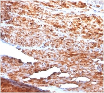 Desmin Antibody Human Uterus Tissue IHC. Immunohistochemistry staining of FFPE human uterus tissue using Desmin antibody (clone rDES/1711) demonstrates strong cytoplasmic staining throughout smooth muscle cell populations, consistent with the abundant expression of Desmin in contractile uterine tissue. Desmin is a type III intermediate filament protein that forms an essential component of the muscle cytoskeleton, helping maintain cellular architecture and mechanical integrity within smooth muscle cells. The widespread immunoreactivity observed within smooth muscle bundles is consistent with the established role of Desmin as a marker of muscle differentiation and smooth muscle tissue identity. Required HIER: boil tissue sections in 10mM citrate buffer, pH 6, for 10-20 min.