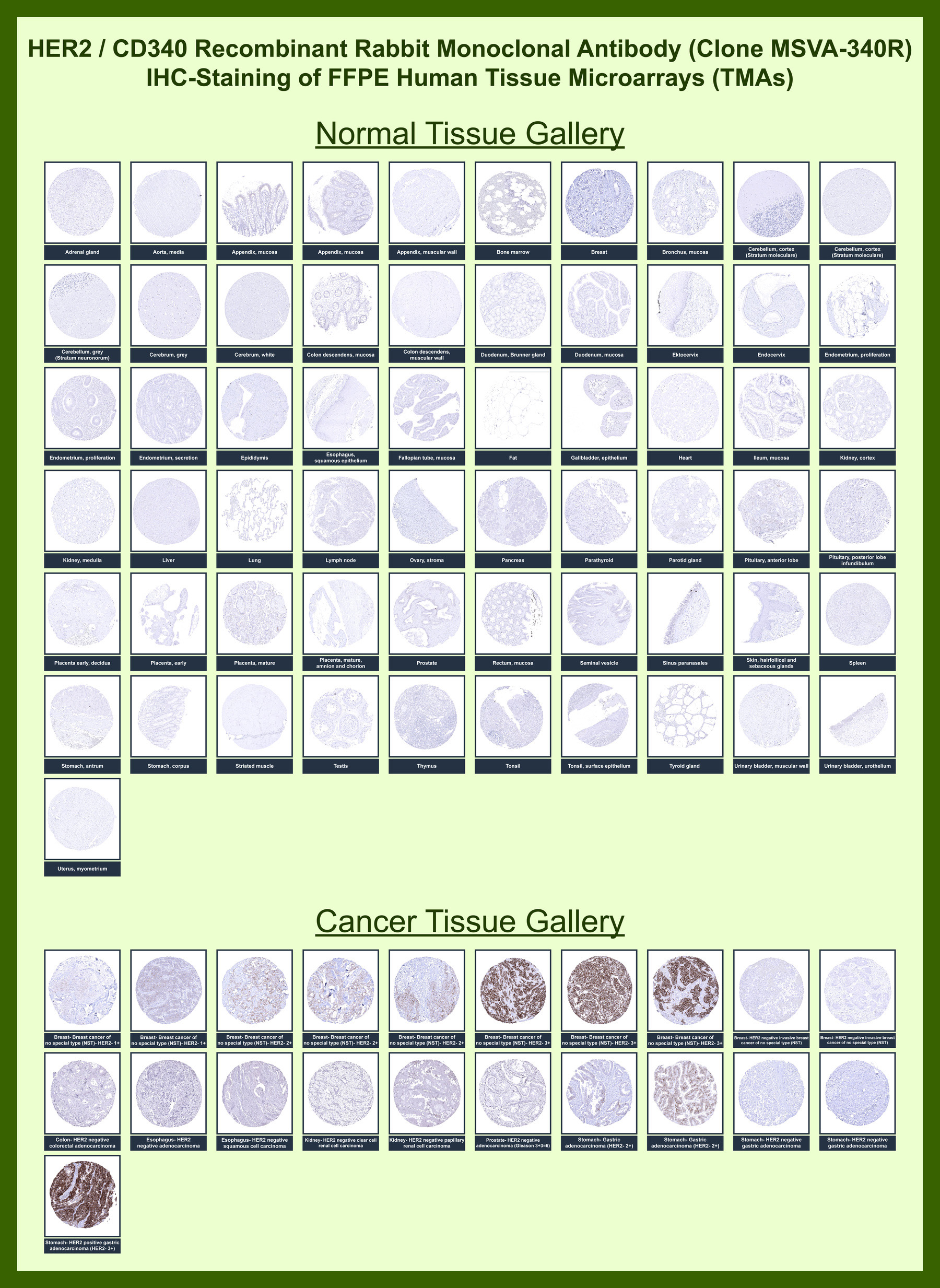<p><strong data-start="154" data-end="228">HER2 Antibody for IHC Tissue Microarray (TMA) Multi-Tissue Expression.</strong> Immunohistochemistry analysis of Receptor tyrosine-protein kinase erbB-2 (ERBB2) expression in FFPE human tissue microarray (TMA) sections using HER2 Antibody for IHC <a href="../tds/her2-antibody-for-ihc-erbb2-immunohistochemistry-antibody-msva-340r-v6152" target="_blank" rel="noopener">clone MSVA-340R</a> demonstrates minimal to absent HRP-DAB brown staining across most normal tissues, with only weak membranous signal in select epithelial compartments. In cancer tissue microarrays, variable to strong circumferential membranous staining is observed in tumor epithelial cells, most prominently in subsets of breast and gastric carcinoma cores, consistent with HER2 overexpression. The clear contrast between HER2-positive tumor cells and largely negative surrounding tissues supports its role as a membrane-associated tumor marker in immunohistochemistry-based analysis. Heat-induced epitope retrieval was performed prior to staining to ensure optimal antigen detection in FFPE sections.</p>