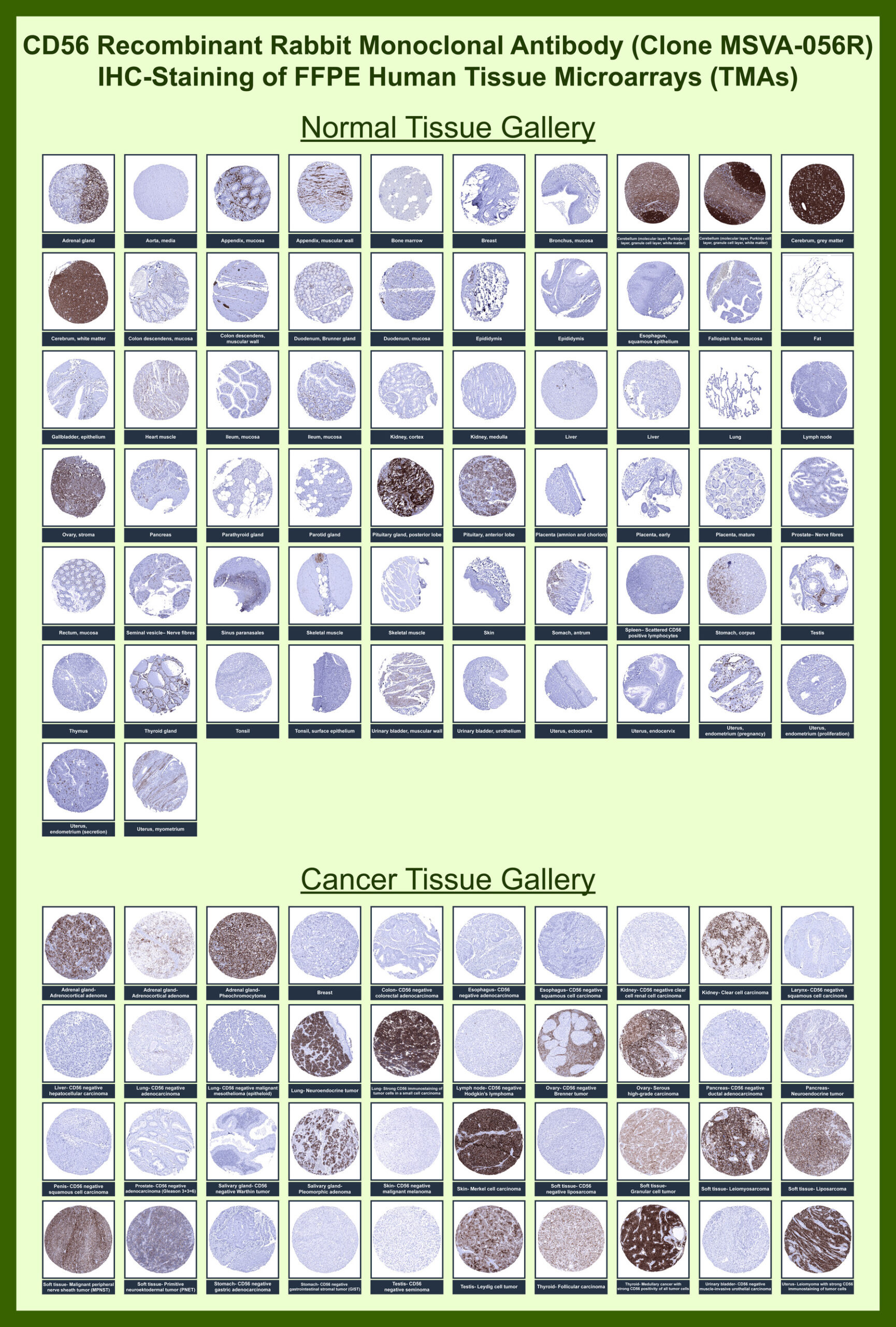 <p><strong data-start="147" data-end="197">CD56 Antibody for IHC Tissue Microarray (TMA).</strong> Immunohistochemistry analysis of CD56 (NCAM1) expression in FFPE human tissue microarrays using clone <a href="../tds/cd56-antibody-for-ihc-ncam1-ihc-antibody-neural-cell-adhesion-molecule-1-msva-056r-v6100" target="_blank" rel="noopener">MSVA-056R</a>. Tissue Microarray (TMA) staining demonstrates membranous and cytoplasmic HRP-DAB brown signal in CD56-positive cell populations, including neural elements, neuroendocrine cells, and subsets of immune cells, while most epithelial tissues show minimal to absent staining. The distribution highlights expected lineage-specific expression and clear contrast across normal and cancer tissues. Observed staining patterns are consistent with publicly available data from the Human Protein Atlas.</p>