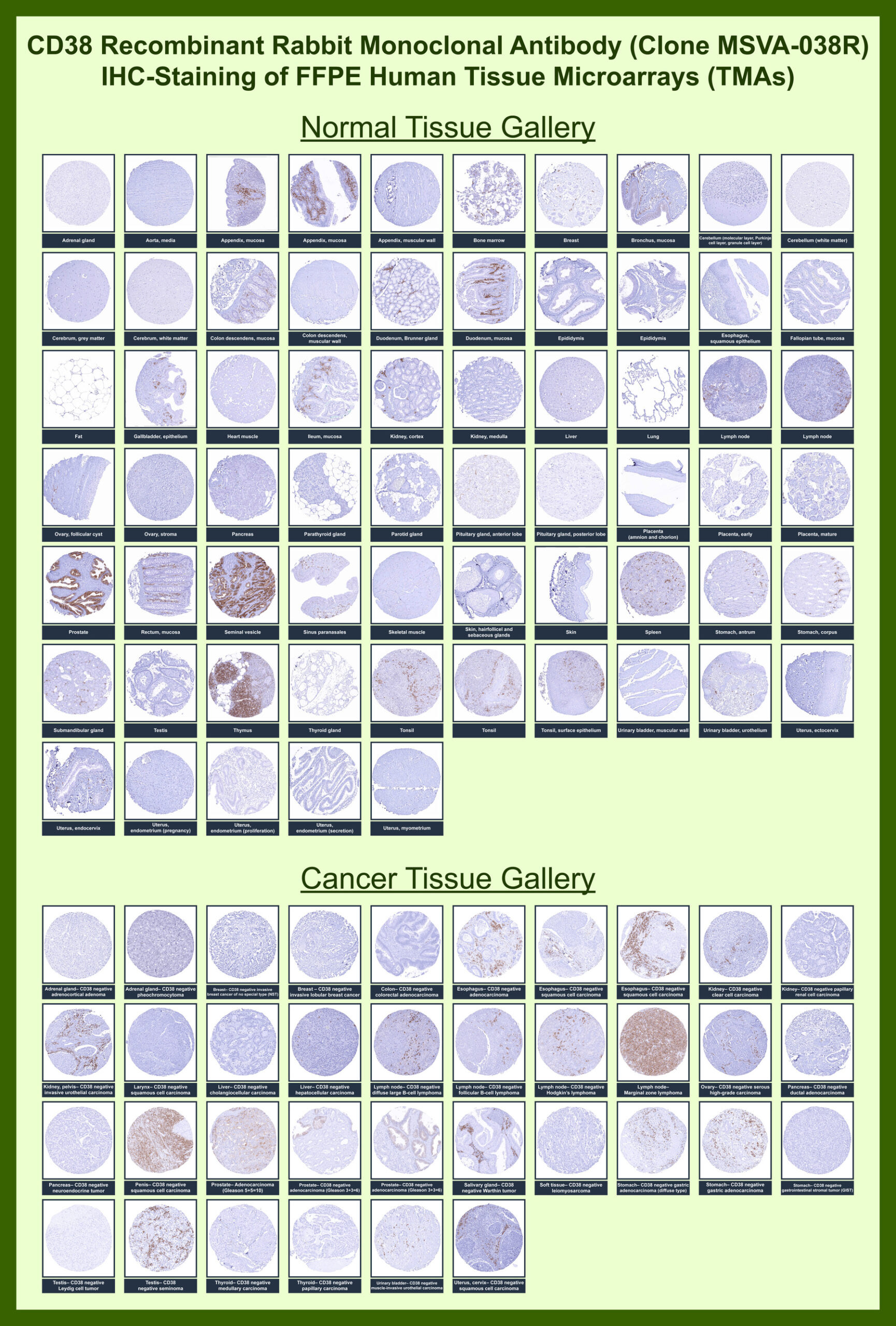 <p><strong data-start="101" data-end="141">CD38 Antibody tissue microarray IHC.</strong> Immunohistochemistry analysis of CD38 expression across formalin-fixed, paraffin-embedded human tissue microarrays using CD38 recombinant rabbit monoclonal antibody clone <a href="../tds/cd38-antibody-for-ihc-cd38-immunohistochemistry-antibody-msva-038r-v6149" target="_blank" rel="noopener">MSVA-038R</a>. Broad panel evaluation shows strong membranous and cytoplasmic HRP-DAB brown staining in plasma cells and activated lymphocytes within lymphoid tissues such as tonsil, lymph node, spleen, and thymus, while most non-lymphoid tissues display low to minimal staining. In cancer tissue arrays, CD38-positive immune cell infiltration is observed across multiple tumor types, with staining localized to tumor-associated lymphocytes rather than malignant epithelial cells. The distribution pattern highlights CD38 as a marker of immune cell presence and lymphoid activity across normal and cancer tissues, consistent with tissue microarray profiling approaches used for large-scale expression analysis.</p>