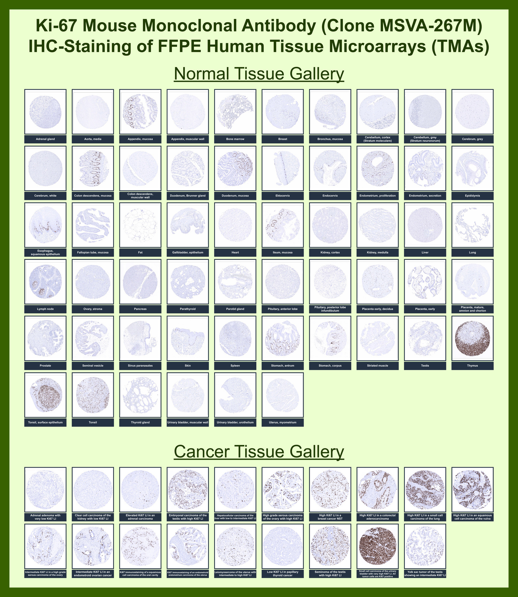 <p><strong data-start="147" data-end="300">Ki67 Antibody for IHC. Immunohistochemistry analysis of Ki67 / MKI67 expression in human tissue microarray (TMA) using Ki67 antibody clone <a href="../tds/ki-67-antibody-for-ihc-ki67-ihc-antibody-marker-of-proliferation-ki-67-msva-267m-v6097">MSVA-267M</a>.</strong> FFPE human tissue microarrays containing a broad range of normal and cancer tissues show nuclear HRP-DAB brown staining in proliferating cell populations, consistent with the expected nuclear localization of the Ki67 proliferation marker. In normal tissues, staining is largely confined to physiologic proliferative compartments including germinal centers, basal epithelial layers, and intestinal crypts, while most differentiated tissues exhibit minimal signal. In cancer tissues, many carcinomas demonstrate increased fractions of Ki67-positive nuclei, reflecting elevated cellular proliferation. The staining pattern aligns with established MKI67 expression profiles and supports the use of Ki67 antibody for tumor proliferation analysis and cancer biomarker research.</p>