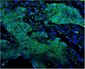 <p>EGFR Antibody Lung Cancer IF. Immunofluorescence analysis of FFPE human lung cancer tissue stained with <a href="../tds/egf-receptor-antibody-rq5881" target="_blank" rel="noopener">EGFR antibody</a> detecting Epidermal growth factor receptor (green). Tumor epithelial cells show strong membranous staining outlining cell borders with additional cytoplasmic signal, consistent with receptor tyrosine kinase localization and active signaling in malignant tissue. The staining highlights dense tumor cell populations within the tumor microenvironment, while surrounding stromal regions show comparatively reduced signal. DAPI nuclear stain (blue) highlights nuclei. HIER: boil tissue sections in pH 8 EDTA for 20 min and allow to cool before testing.</p>