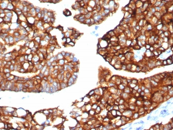 <p>IHC staining of FFPE human lung carcinoma tissue with Cytokeratin 7 antibody (<a href="../tds/cytokeratin-7-antibody-krt78121r-v4285" target="_blank" rel="noopener">clone KRT7/8121R, cat # V4285</a>).</p>