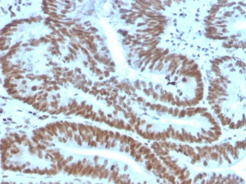 <p>BMI1 Antibody Stem Cell Marker IHC. Immunohistochemistry analysis of FFPE human colon carcinoma tissue using <a href="../tds/bmi1-antibody-bmi12823-v8080">BMI1 antibody clone BMI1/2823</a>. Tumor epithelial cell nuclei demonstrate strong HRP-DAB brown staining consistent with the chromatin-associated localization of BMI1 in polycomb-mediated transcriptional repression, stem cell self-renewal signaling, and epigenetic regulation pathways associated with proliferative cancer stem cell phenotypes in colorectal carcinoma tissue. Nuclei are counterstained blue. Heat-induced epitope retrieval was performed by boiling tissue sections in pH9 10 mM Tris with 1 mM EDTA for 20 minutes followed by cooling prior to staining.</p>