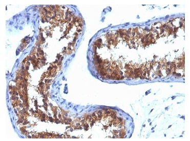 <p><strong data-start="271" data-end="288">MVP Antibody.</strong> Immunohistochemistry analysis of Major Vault Protein (MVP / LRP) expression in formalin-fixed, paraffin-embedded human testicular carcinoma using <a href="../tds/major-vault-protein-antibody-1032-v3043" target="_blank" rel="noopener">clone 1032</a> mouse monoclonal antibody. Tumor epithelial cells show strong cytoplasmic HRP-DAB brown staining with a diffuse to granular pattern, while surrounding stromal elements display minimal background signal. The staining highlights malignant cell populations within glandular tumor structures, supporting the role of Major vault protein in tumor cell survival and cellular stress response pathways relevant to drug resistance.</p>