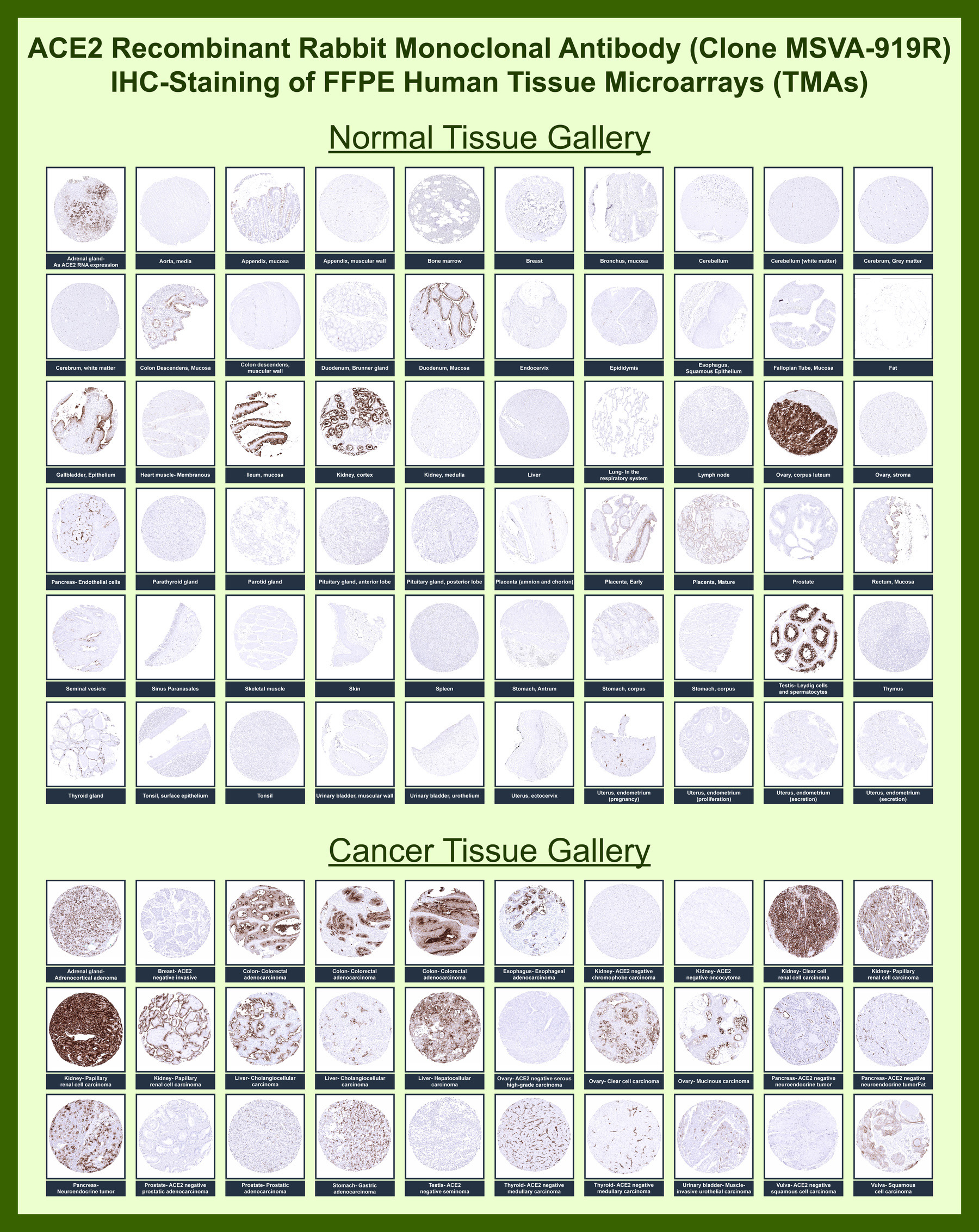 <p><strong data-start="378" data-end="420">ACE2 Antibody Tissue Microarray (TMA).</strong> Immunohistochemical staining of Angiotensin converting enzyme 2 (ACE2) across a comprehensive human tissue microarray using ACE2 antibody. The TMA panel includes a wide range of normal and malignant tissues, enabling side-by-side comparison of ACE2 expression patterns under standardized conditions. In normal tissues, staining is primarily localized to epithelial cell populations, with distinct membranous and apical signal observed in organs such as kidney, intestine, gallbladder, and select glandular structures, while stromal and connective tissues remain largely negative. In cancer tissues, variable <a href="../tds/ace2-antibody-for-ihc-angiotensin-converting-enzyme-2-antibody-for-ihc-msva-919r-v6108" target="_blank" rel="noopener">ACE2 expression</a> is detected across tumor types, with stronger staining observed in subsets of renal, gastrointestinal, and hepatocellular carcinomas, reflecting retained epithelial differentiation. This tissue microarray analysis highlights the distribution of ACE2 as a cell surface enzyme and viral entry receptor, providing spatial context for studies of tissue biology, disease progression, and SARS-CoV-2 susceptibility.</p>