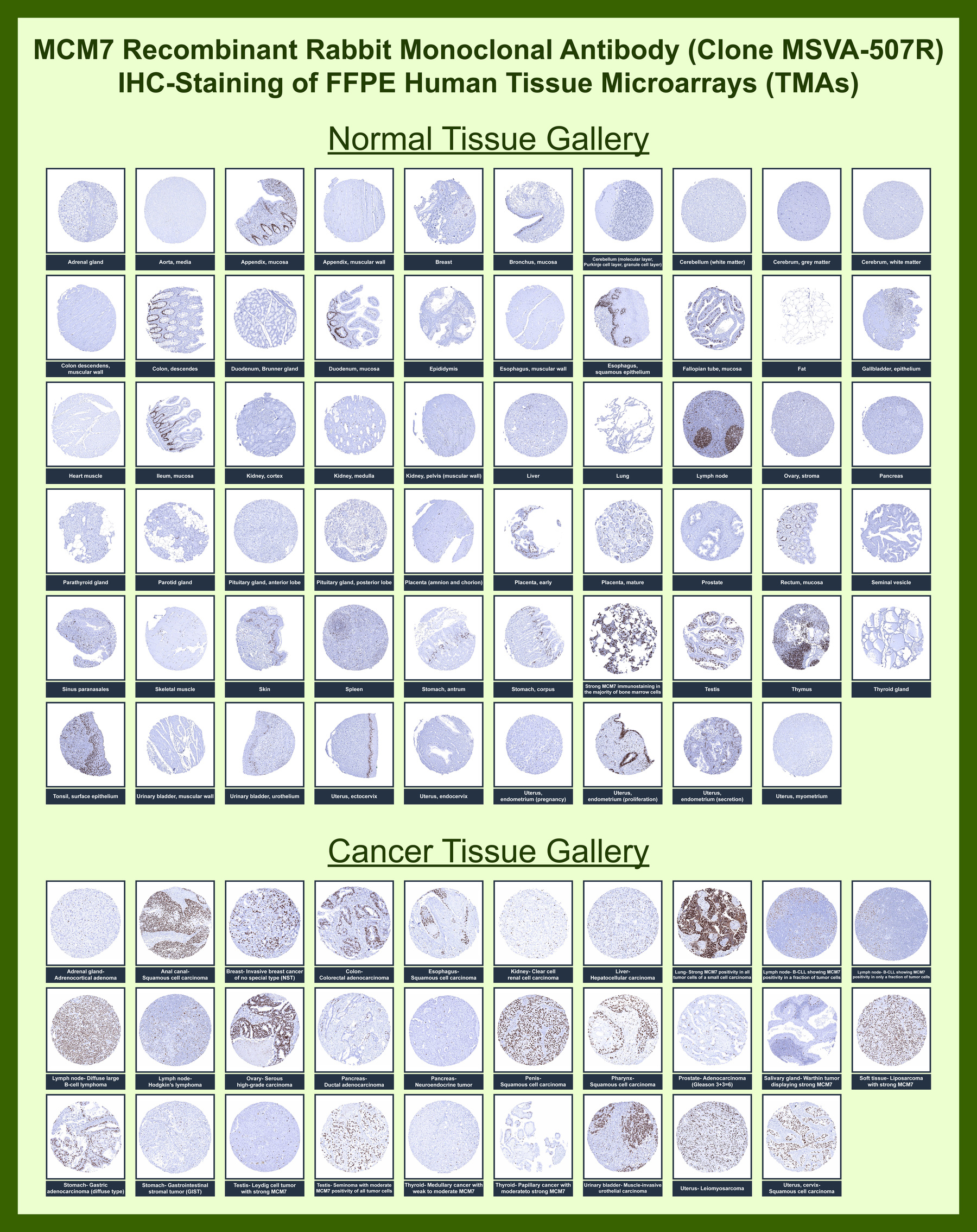 <p><strong data-start="989" data-end="1035">MCM7 Antibody IHC Tissue Microarray (TMA).</strong> Immunohistochemistry analysis of Minichromosome maintenance protein 7 (MCM7) across human tissue microarray (TMA) panels using <a href="../tds/mcm7-antibody-for-ihc-minichromosome-maintenance-protein-7-msva-507r-v6095">MCM7 antibody</a>. Nuclear staining highlights proliferating cells in multiple normal and cancer tissues, with strong signal in germinal centers and tumor regions consistent with active DNA replication and cell cycle progression.</p>