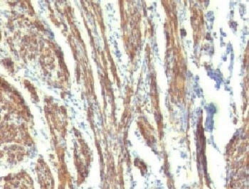 <p><strong data-start="0" data-end="54" data-is-only-node="">Caldesmon Antibody Human Uterus Smooth Muscle IHC.</strong> Immunohistochemistry analysis of FFPE human uterus tissue using Caldesmon Antibody <a href="../tds/cad-antibody-cald1-caldesmon-hmw-cdsm-3-v7159">clone CDSM-3</a> demonstrates strong HRP-DAB brown cytoplasmic staining throughout smooth muscle cells of the myometrium. The staining pattern highlights elongated smooth muscle fibers arranged in characteristic interlacing bundles and is consistent with the established expression of Caldesmon (CALD1), an actin- and myosin-associated regulatory protein involved in cytoskeletal organization, contractile function, and smooth muscle differentiation. This image illustrates the prominent smooth muscle localization of CALD1 and supports studies of smooth muscle biology, contractile regulation, and vascular-associated cytoskeletal signaling pathways.</p>