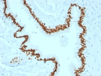 <p><strong data-start="0" data-end="40" data-is-only-node="">Transcription Factor Antibodies IHC.</strong> Immunohistochemistry analysis of FFPE human lung carcinoma tissue stained with SOX2 Antibody / Stem Cell Transcription Factor Marker clone SOX2/1791 demonstrates strong nuclear HRP-DAB brown staining in malignant epithelial cells, consistent with the established role of SOX2 as a lineage-associated transcription factor involved in stemness regulation, cellular plasticity, and tumor progression in squamous and pulmonary malignancies. Required HIER: boil tissue sections in 10mM citrate buffer, pH 6, for 10-20 min followed by cooling at room temperature for 20 min.</p>
