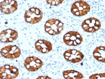 <p>IHC testing of human colon with Cytokeratin 20 antibody (<a href="../tds/ck20-antibody-cytokeratin-20-krt20-krt201993-v7323" target="_blank" rel="noopener">clone KRT20/1993, cat # V7323</a>).</p>