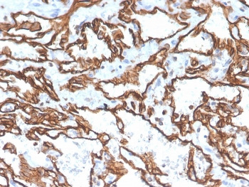 <p>IHC staining of FFPE human angiosarcoma with CD31 antibody (<a href="../tds/cd31-antibody-pecam-1-pecam13529-v8297" target="_blank" rel="noopener">clone PECAM1/3529, cat # V8297</a>). HIER: boil tissue sections in pH 9 10mM Tris with 1mM EDTA for 10-20 min and allow to cool before testing.</p>