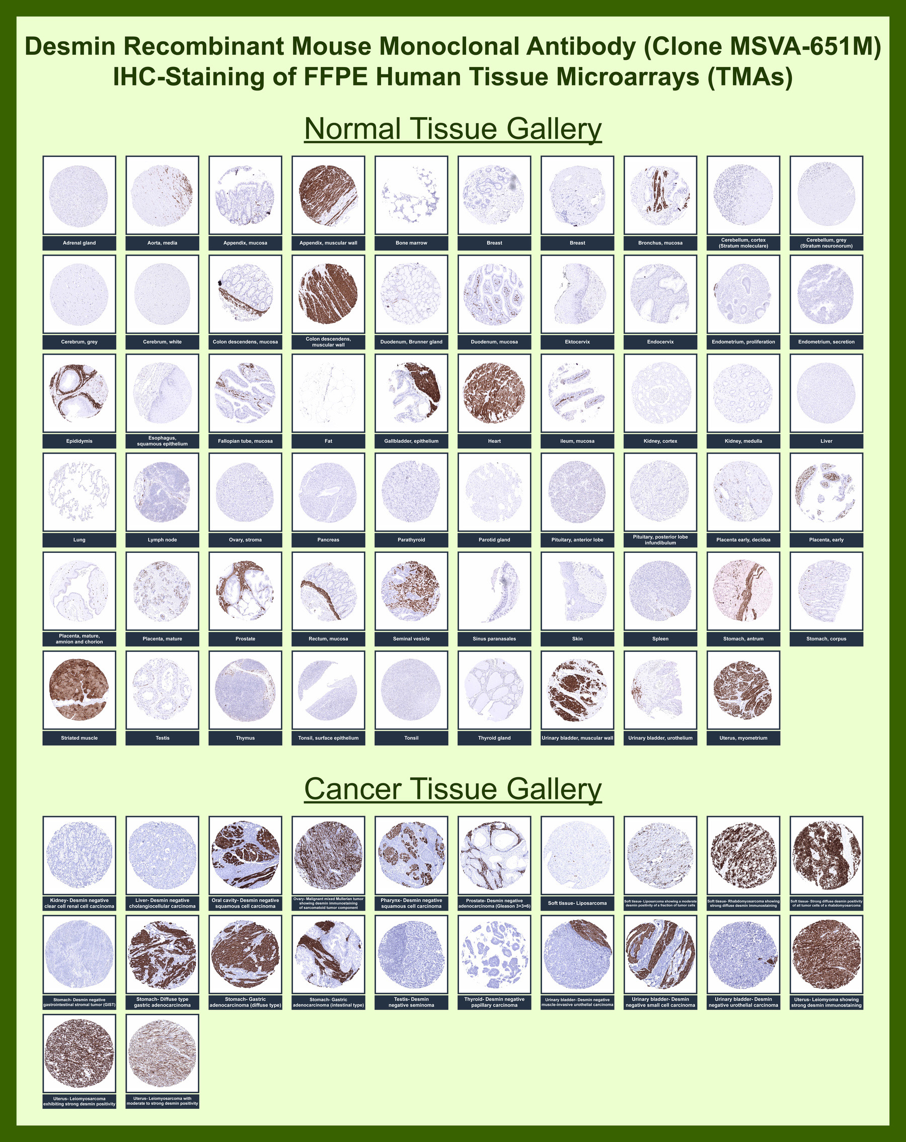 <p><strong data-start="4497" data-end="4574">Desmin Antibody Tissue Microarray (TMA) Multi-Tissue Expression Analysis.</strong> Immunohistochemistry analysis of Desmin (DES) expression in FFPE human tissue microarray (TMA) sections using <a href="../tds/desmin-antibody-for-ihc-des-immunohistochemistry-antibody-msva-651m-v5869" target="_blank" rel="noopener">clone MSVA-651M</a> demonstrates strong cytoplasmic HRP-DAB brown staining in skeletal, cardiac, and smooth muscle tissues, while cancer tissue microarrays show diffuse cytoplasmic staining in tumors with myogenic differentiation, supporting its role as a muscle lineage marker.</p>