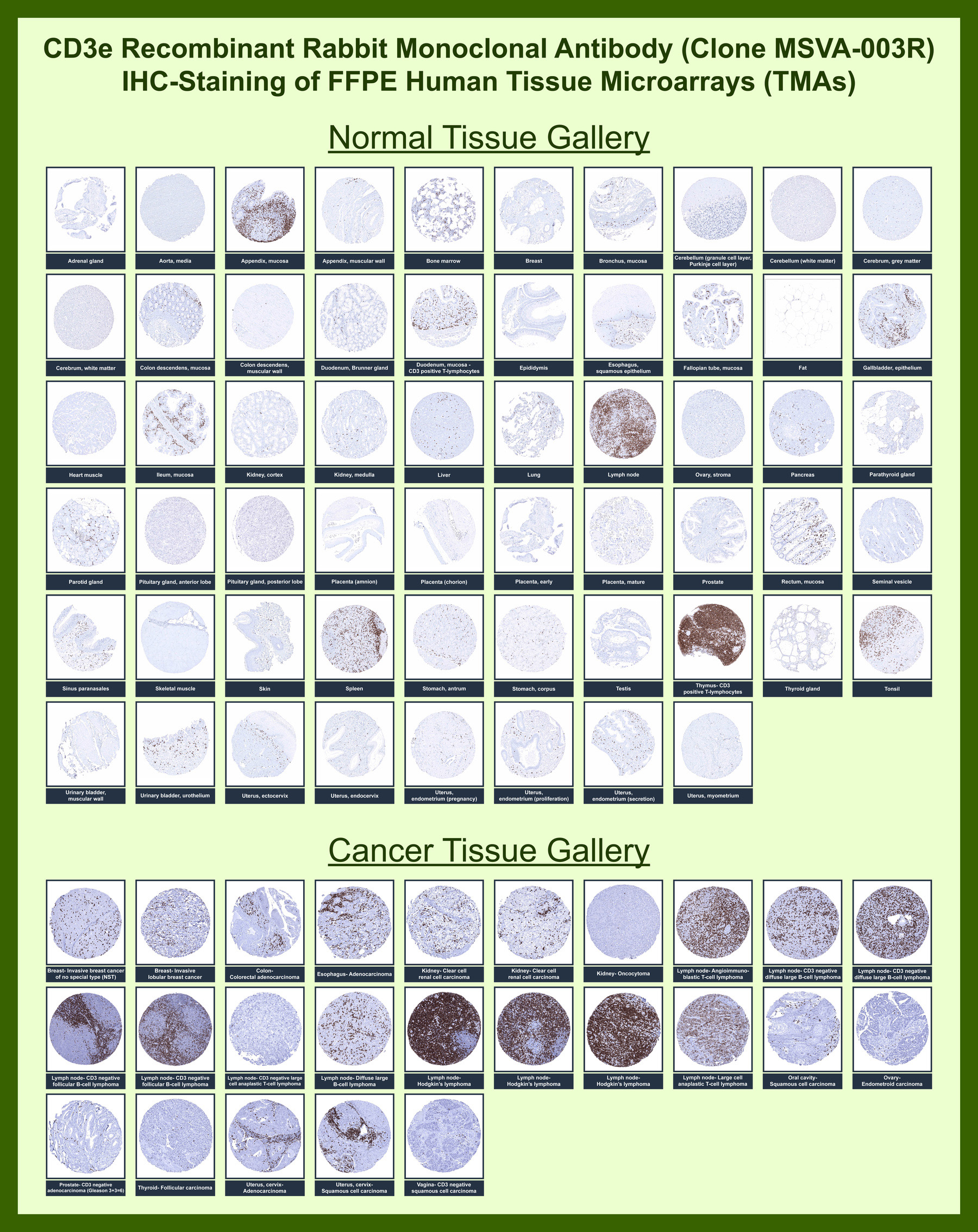 <p><strong data-start="188" data-end="233">CD3 Antibody Tissue Microarray (TMA) IHC.</strong> Immunohistochemistry analysis of CD3 / CD3 antigen expression across human tissue microarrays containing a wide range of normal and cancer tissues using antibody. Strong HRP-DAB brown membranous and cytoplasmic staining highlights T lymphocytes in lymphoid-rich tissues such as tonsil, lymph node, and spleen, while most non-lymphoid tissues show minimal background signal. In cancer samples, variable densities of CD3-positive tumor-infiltrating lymphocytes are observed, reflecting differences in immune cell infiltration across tumor types. This staining pattern supports the use of CD3 antibody as a marker for T cell distribution, immune contexture, and tumor-associated immune responses in FFPE tissue microarrays.</p>
