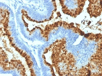 <p>IHC: Formalin-fixed, paraffin-embedded human colon carcinoma stained with Blood Group B antibody (<a href="../tds/abo-antibody-blood-group-antigen-b-heb-20-v2552" target="_blank" rel="noopener">clone HEB-20, cat # V2552</a>).</p>