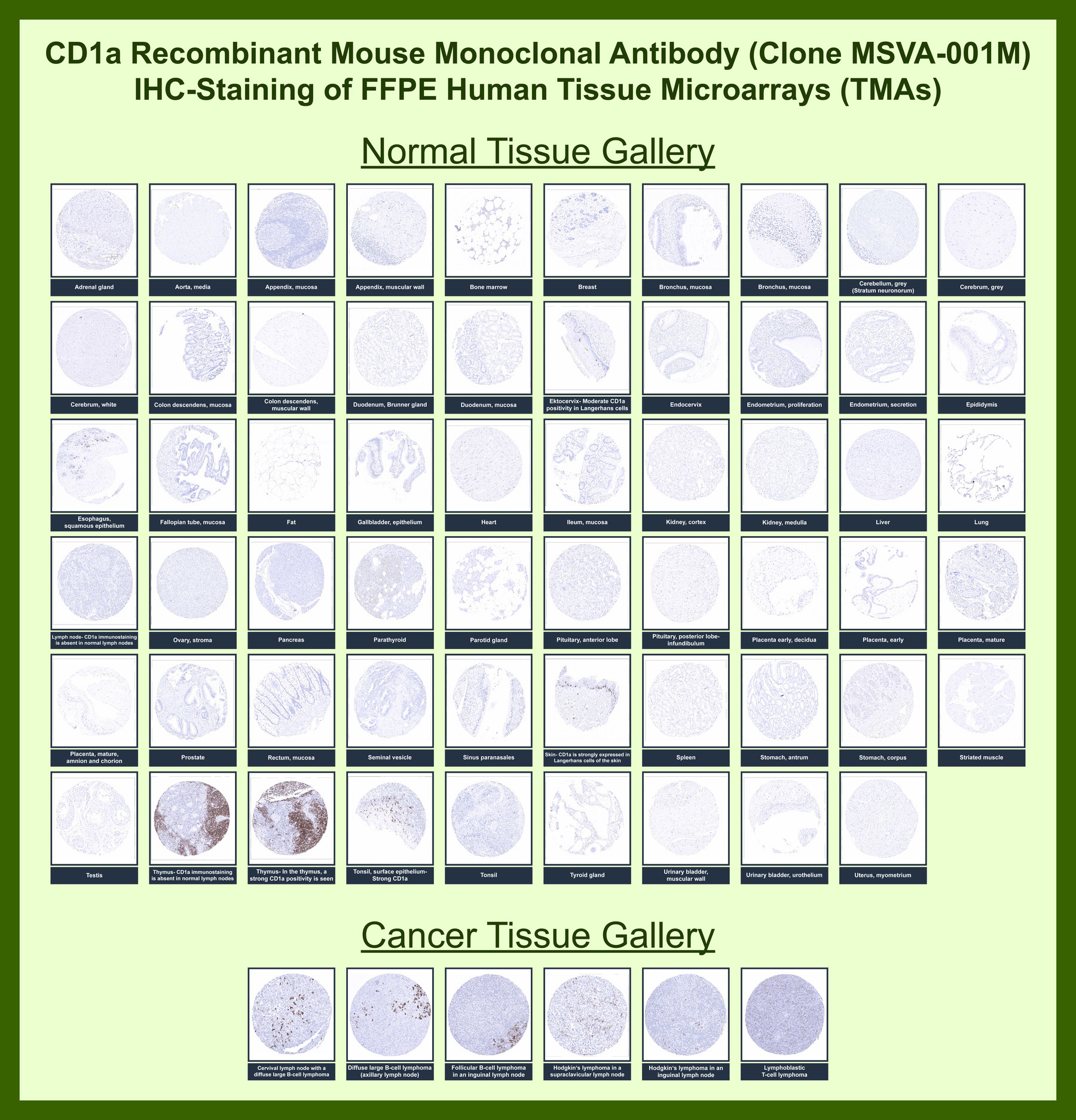 <p><strong data-start="5480" data-end="5498">CD1A Antibody.</strong> Immunohistochemistry analysis of CD1A / CD1a expression in human tissue microarray (TMA) containing multiple normal and cancer tissues using CD1A Antibody (<a href="../tds/cd1a-antibody-for-ihc-cd1a-immunohistochemistry-antibody-msva-001m-v6138">Cat # V6138</a>). Membranous and cytoplasmic staining is observed in dendritic cells, with strong signal in Langerhans cells of epithelial tissues, while most non-immune cell types remain negative. The staining pattern highlights tissue-resident antigen-presenting cells and supports evaluation of immune cell distribution across diverse tissue types.</p>