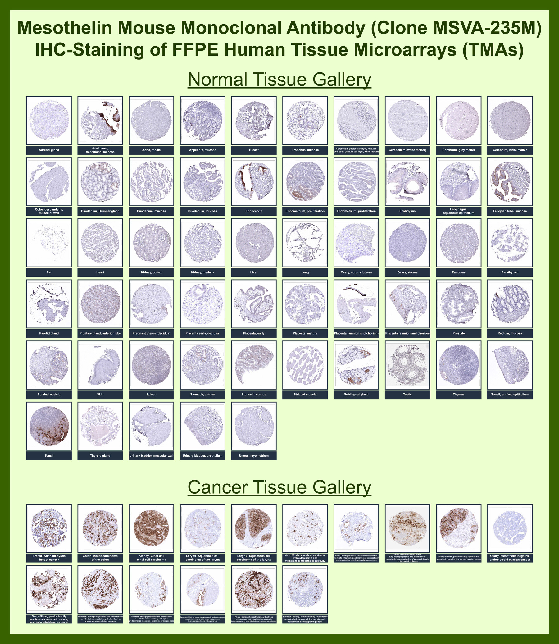<p><strong data-start="133" data-end="165">Mesothelin Antibody TMA IHC.</strong> Immunohistochemistry analysis of mesothelin (MSLN) expression in FFPE human tissue microarrays using clone MSVA-235M. Tissue Microarray (TMA) staining demonstrates strong membranous HRP-DAB brown signal in mesothelin-positive tumor types, including ovarian carcinoma, pancreatic adenocarcinoma, and mesothelioma, while most normal tissues exhibit minimal to absent staining consistent with restricted mesothelial expression. The staining pattern highlights clear tumor-to-normal contrast across diverse tissue types, supporting use as a tumor-associated marker in epithelial malignancies. Observed expression profiles are consistent with publicly available data from the Human Protein Atlas.</p>