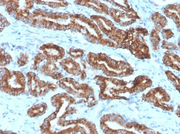 <p><strong data-start="0" data-end="42" data-is-only-node="">p504S Antibody Prostate Carcinoma IHC.</strong> Immunohistochemistry analysis of FFPE human prostate carcinoma tissue using p504S Antibody <a href="../tds/p504s-antibody-amacr-13h4-v2505s">clone 13H4</a> demonstrates strong HRP-DAB brown cytoplasmic staining throughout malignant glandular epithelial cells. The staining pattern is consistent with the established expression of Alpha-methylacyl-CoA racemase (AMACR/p504S), a metabolic enzyme involved in branched-chain fatty acid metabolism and a widely studied marker in prostate cancer research. This image highlights robust tumor-associated expression within neoplastic prostate glands and supports investigations into prostate carcinoma biology and metabolic regulation. HIER: boil tissue sections in pH 9 10mM Tris with 1mM EDTA for 20 min and allow to cool before testing.</p>