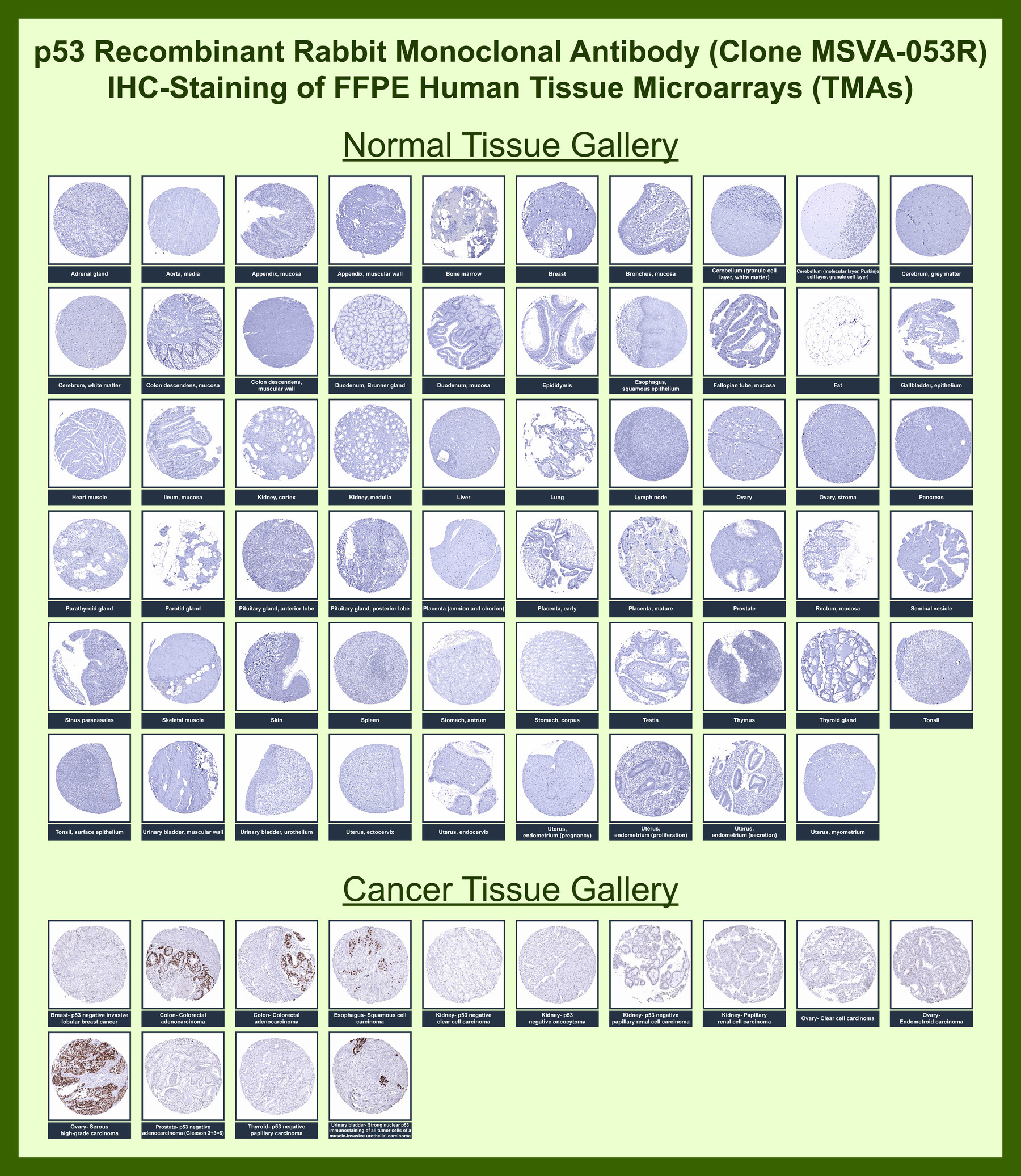 <p><strong data-start="142" data-end="291">p53 Antibody for IHC. Immunohistochemistry analysis of p53 / TP53 expression in human tissue microarray (TMA) using p53 antibody clone <a href="../tds/p53-antibody-for-ihc-p53-immunohistochemistry-antibody-msva-053r-v6124" target="_blank" rel="noopener">MSVA-053R</a>.</strong> FFPE human tissue microarrays containing multiple normal and cancer tissues were stained, showing predominantly nuclear HRP-DAB brown signal in subsets of tumor cells, consistent with accumulation of Tumor protein p53 in neoplastic tissues, while most normal tissues display weak or minimal nuclear staining. Strong nuclear signal is observed in colorectal, breast, ovarian, and additional carcinoma samples, whereas non-neoplastic tissues exhibit low basal expression. The staining distribution reflects established TP53 expression patterns and supports the use of p53 antibody for cancer biomarker analysis and tumor biology research.</p>