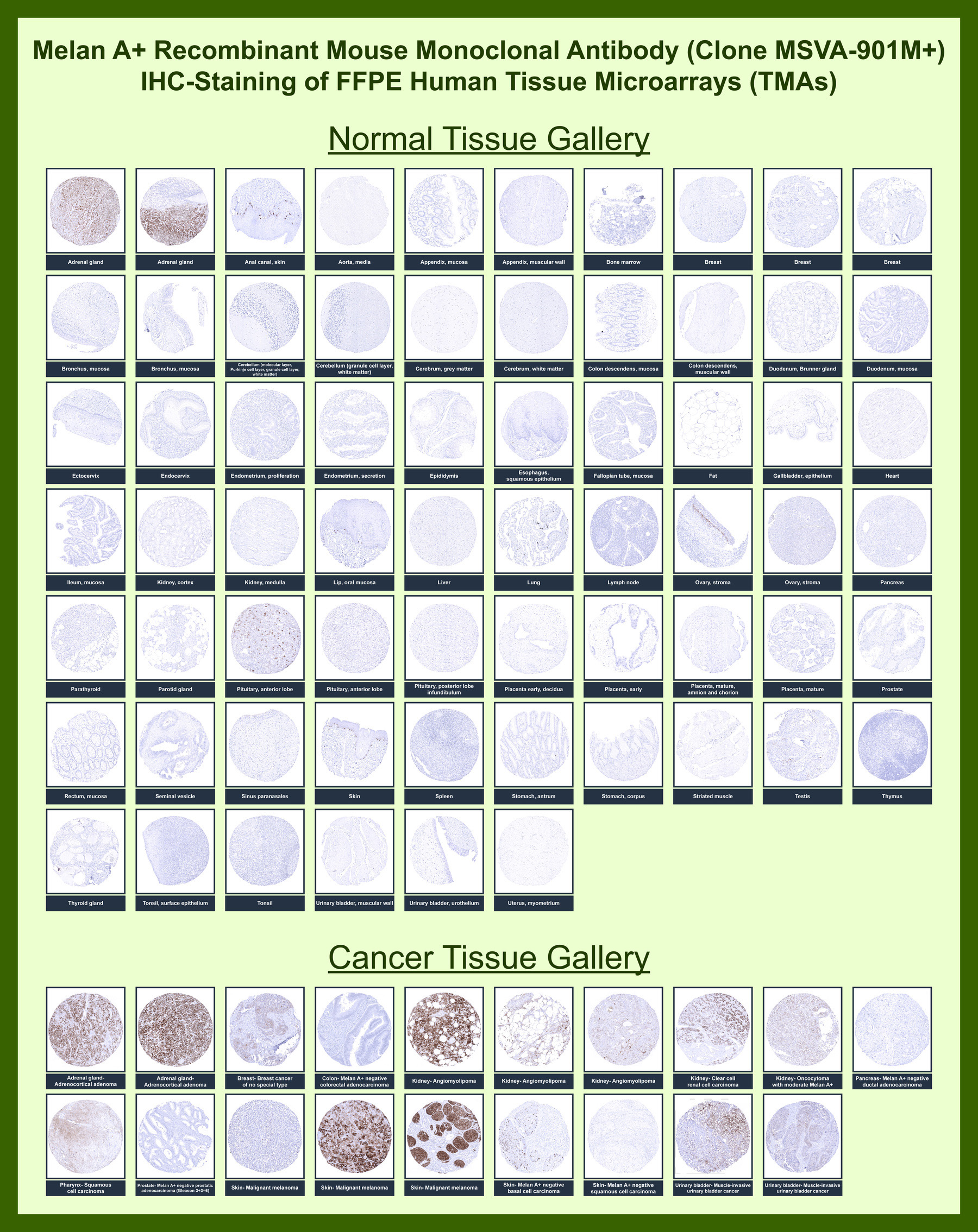 <p><strong data-start="932" data-end="1001">Melan A Antibody Tissue Microarray (TMA) multi-tissue expression.</strong> Analysis of Melan A (MLANA) distribution in FFPE human tissue microarray (TMA) sections using <a href="../tds/melan-a-antibody-for-ihc-mlana-immunohistochemistry-antibody-msva-901m-v5892" target="_blank" rel="noopener">Melan A Antibody clone MSVA-901M+</a> demonstrates strong cytoplasmic staining in melanocytic cells and melanoma tumor samples, while non-melanocytic tissues remain largely negative. The staining pattern highlights melanocyte lineage specificity and clear contrast across diverse tissue types, consistent with known MLANA expression profiles.</p>
