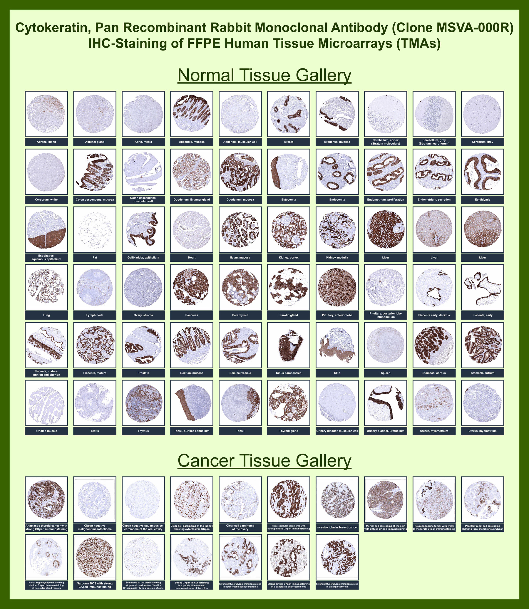 <p><strong data-start="5354" data-end="5417">Pan Cytokeratin Antibody human tissue microarray (TMA) IHC.</strong> Immunohistochemistry analysis of cytokeratin expression in formalin-fixed, paraffin-embedded human tissue microarray using Pan Cytokeratin Antibody <a href="../tds/pan-cytokeratin-antibody-for-ihc-broad-spectrum-epithelial-marker-antibody-msva-000r-v6151">MSVA-000R</a>. The human tissue microarray (TMA) contains a broad range of normal and cancer tissues, enabling comprehensive evaluation of epithelial distribution. Strong cytoplasmic HRP-DAB brown staining is observed across epithelial compartments including glandular, ductal, and stratified epithelia, while stromal, mesenchymal, and lymphoid tissues remain largely negative. In cancer tissues, diffuse staining highlights epithelial tumor cells and clearly delineates carcinoma structures within complex tumor microenvironments.</p>