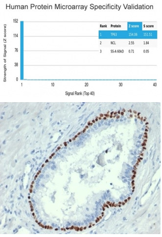 <p><strong data-start="147" data-end="329">p63 Antibody for IHC. Immunohistochemistry analysis of p63 / TP63 expression in human prostate cancer tissue and protein microarray specificity validation using clone TP63/4379R.</strong> FFPE human prostate cancer tissue stained with recombinant p63 antibody shows strong nuclear HRP-DAB brown signal in basal-type epithelial cells, with surrounding stromal cells largely negative, consistent with the known nuclear localization of Tumor protein p63. Antigen retrieval was performed using Tris-EDTA buffer (pH 9) to enhance epitope accessibility. In parallel, protein microarray analysis using a HuProt array containing over 19,000 full-length human proteins demonstrates highly selective binding of clone TP63/4379R to TP63, with a dominant top-ranked signal, high Z-score, and strong separation from non-target proteins. Minimal off-target interaction and clear signal discrimination support the specificity of this p63 antibody for TP63 detection in tissue-based and proteome-wide applications.</p>