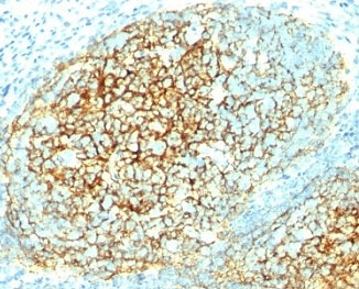 <p><strong data-start="0" data-end="37" data-is-only-node="">VCAM-1 Antibody Human Tonsil IHC.</strong> Immunohistochemistry analysis of FFPE human tonsil tissue using VCAM-1 Antibody clone 1.4C3 demonstrates strong HRP-DAB brown membranous staining within lymphoid cell populations. The staining pattern is consistent with the established role of Vascular Cell Adhesion Molecule 1 (VCAM-1/CD106) in leukocyte adhesion, immune cell trafficking, and inflammatory signaling. Prominent cell-surface staining highlights immune cell interactions within secondary lymphoid tissue and supports studies of endothelial activation, adaptive immunity, and leukocyte recruitment pathways.</p>