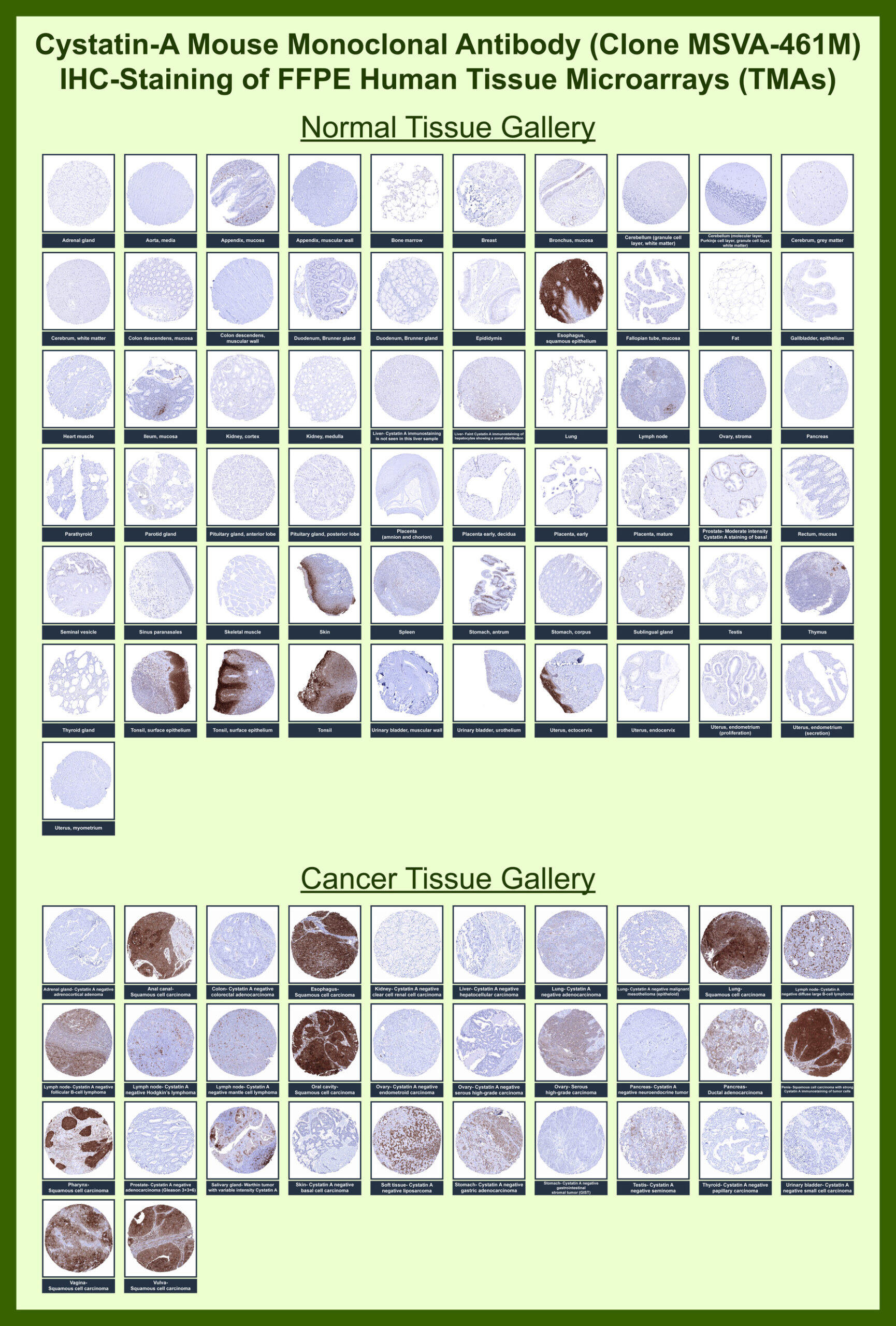 <p><strong data-start="4497" data-end="4578">Cystatin A Antibody Tissue Microarray (TMA) Multi-Tissue Expression Analysis.</strong> Immunohistochemistry analysis of Cystatin A (CSTA) expression in FFPE human tissue microarray (TMA) sections demonstrates strong cytoplasmic HRP-DAB brown staining in stratified squamous epithelia in normal tissues, while cancer tissue microarrays show diffuse cytoplasmic staining in squamous cell carcinoma tumor cells with minimal background in non-epithelial tissues, supporting its role as a squamous epithelial marker.</p>