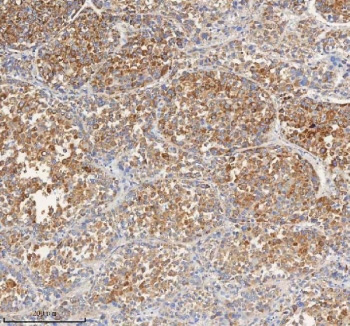 <p><strong data-start="0" data-end="35" data-is-only-node="">PCCA Antibody Liver Cancer IHC.</strong> Immunohistochemistry analysis of FFPE human liver cancer tissue using PCCA Antibody demonstrates widespread HRP-DAB brown cytoplasmic staining throughout tumor cell populations. The staining pattern is consistent with the established mitochondrial localization of Propionyl-CoA carboxylase subunit alpha (PCCA), a key metabolic enzyme involved in branched-chain amino acid catabolism, propionate metabolism, and cellular energy homeostasis. HIER: boil tissue sections in pH8 EDTA for 20 min and allow to cool before testing.</p>