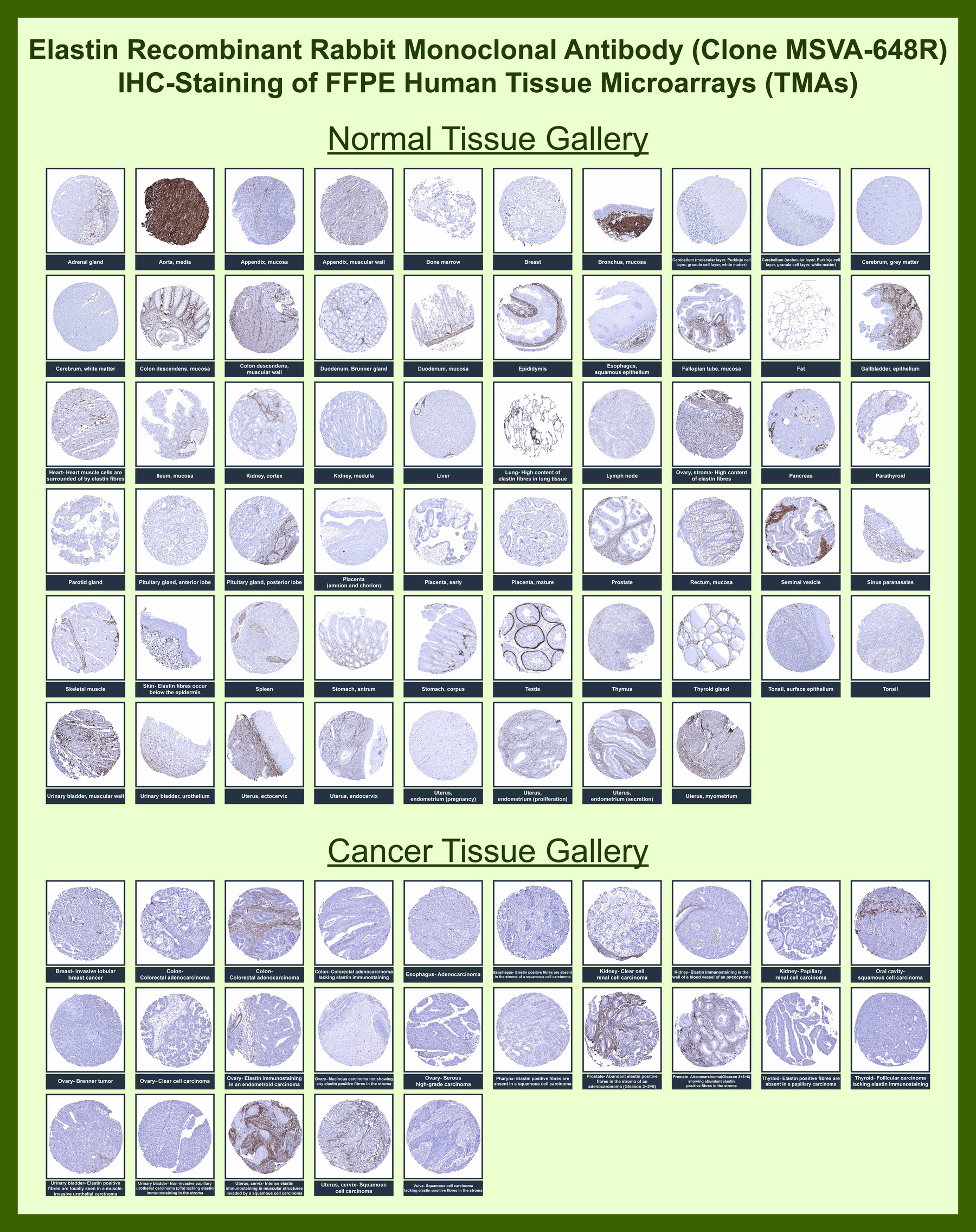 <p><strong data-start="125" data-end="194">Elastin Antibody Tissue Microarray (TMA) Multi-Tissue Expression.</strong> Analysis of Elastin (ELN) distribution in FFPE human tissue microarray (TMA) sections using Elastin Antibody <a href="../tds/elastin-antibody-for-ihc-eln-immunohistochemistry-antibody-msva-648r-v5870" target="_blank" rel="noopener">clone MSVA-648R</a> demonstrates extracellular localization of elastic fiber networks in vascular, pulmonary, and connective tissue compartments, while epithelial and most cellular regions remain largely negative. In cancer tissue arrays, elastin highlights stromal and vascular-associated extracellular matrix structures with variable organization depending on tumor type. The distinct extracellular staining pattern outlines tissue architecture and elastic fiber organization across diverse tissue types, consistent with known elastin distribution and publicly available reference datasets.</p>