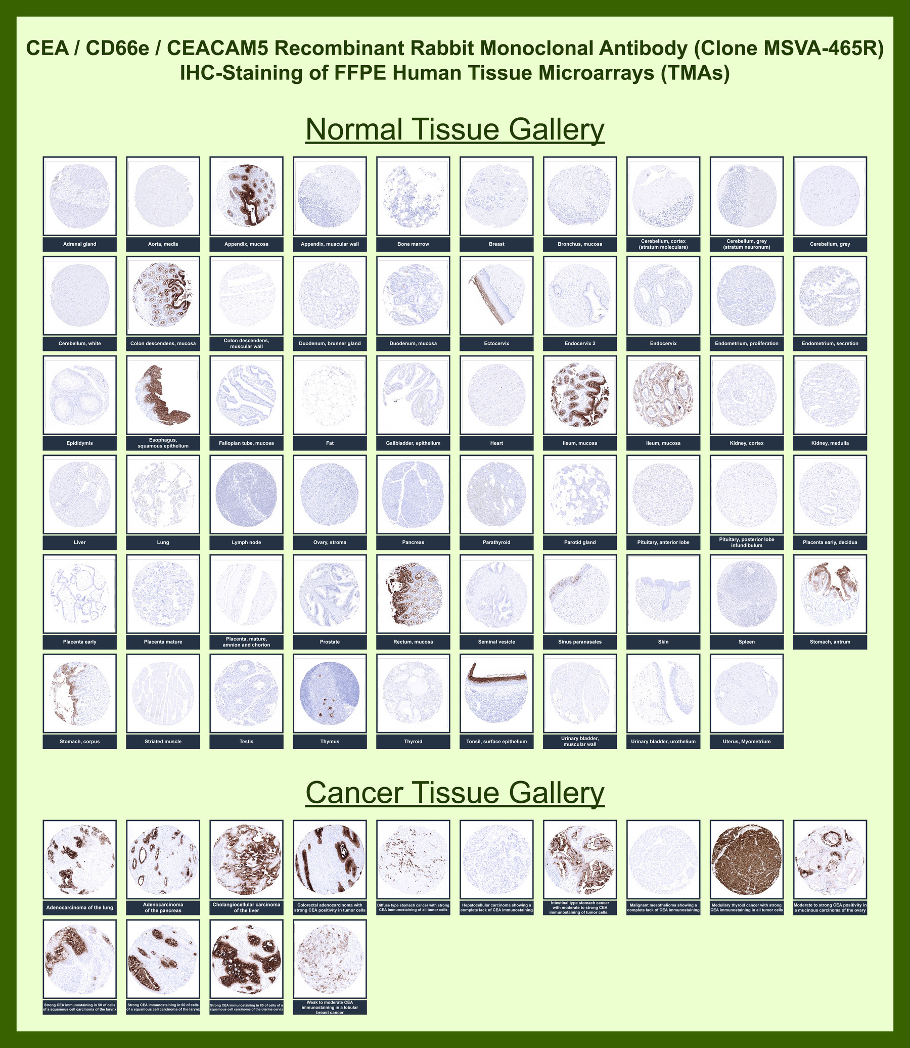 <p><strong data-start="4817" data-end="4891">CEA Antibody Tissue Microarray (TMA) Multi-Tissue Expression Analysis.</strong> Immunohistochemistry analysis of Carcinoembryonic antigen (CEACAM5) expression in FFPE human tissue microarray (TMA) sections using clone <a href="../tds/cea-antibody-for-ihc-ceacam5-immunohistochemistry-antibody-msva-465r-v5853" target="_blank" rel="noopener">MSVA-465R</a> demonstrates epithelial-restricted HRP-DAB brown staining in normal tissues with apical and luminal localization, while cancer tissue microarrays show strong membranous and cytoplasmic staining in tumor epithelial cells across multiple carcinoma types, supporting its role as an epithelial tumor marker.</p>